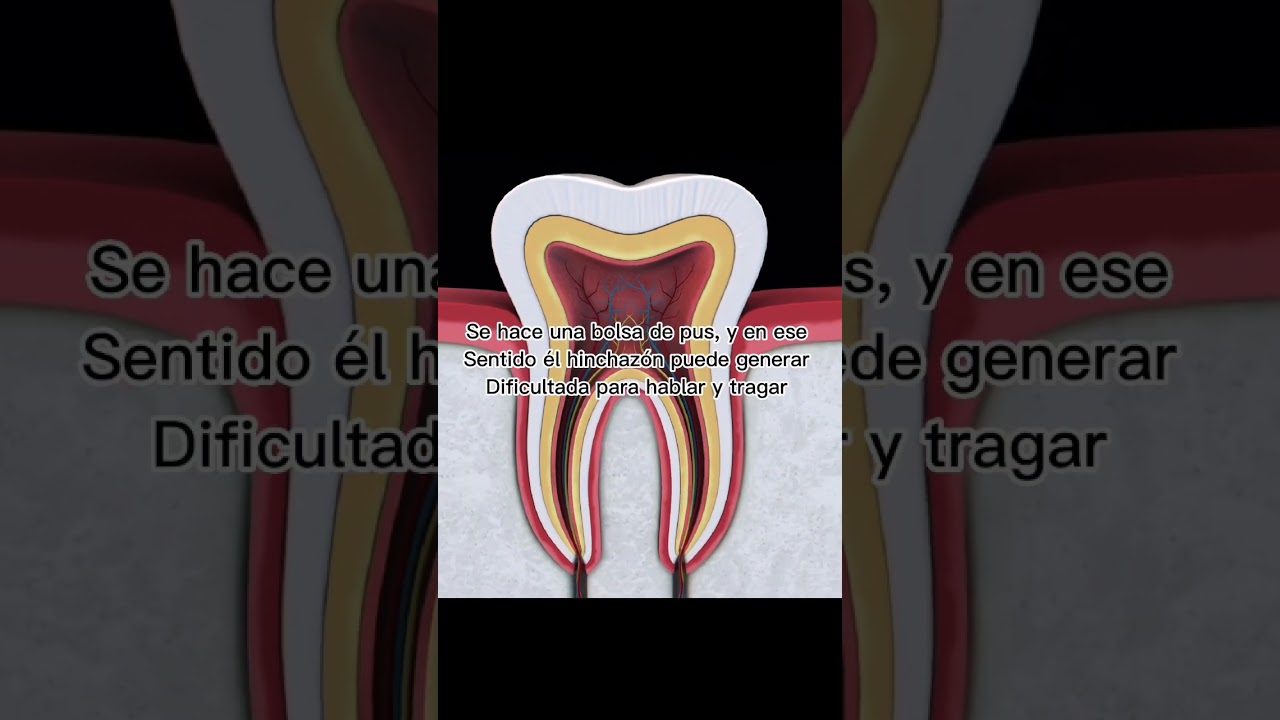 absceso dental puede provocar la muerte