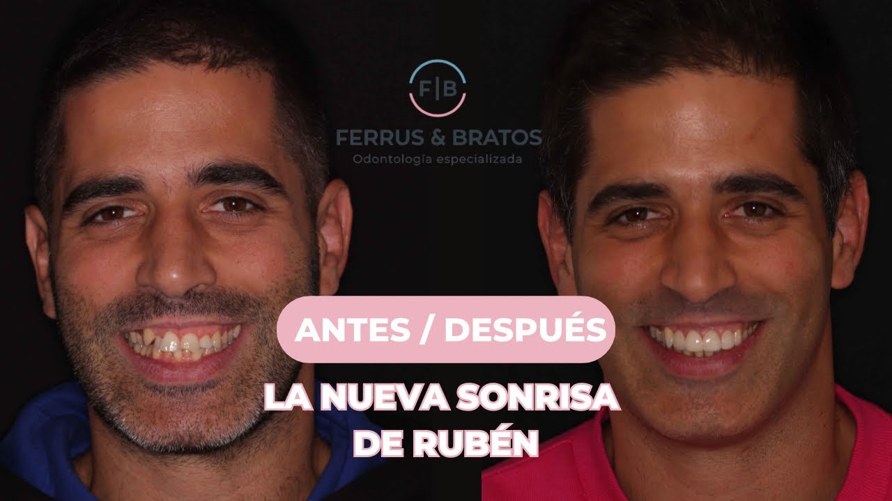 carillas dentales fotos antes y después