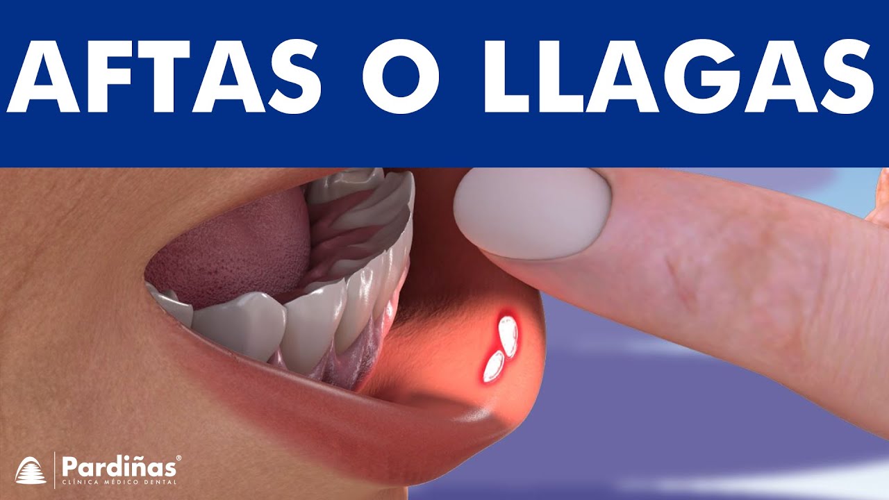 como curar las aftas de la boca