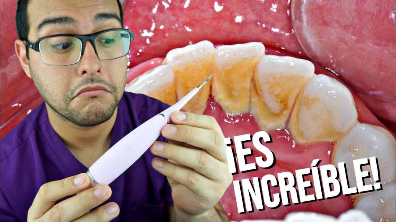 como quitar el sarro de los dientes en casa