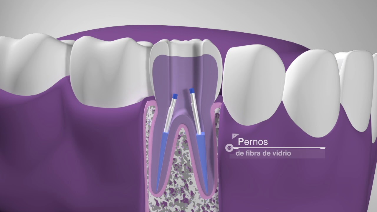 como se hace una endodoncia en muela