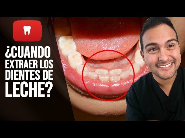 diente de leche que se mueve pero no se cae
