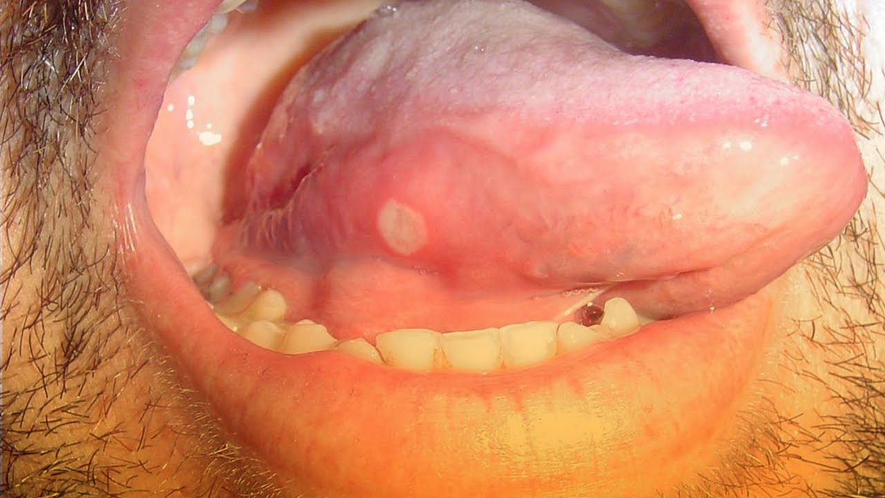 el herpes puede salir en la lengua