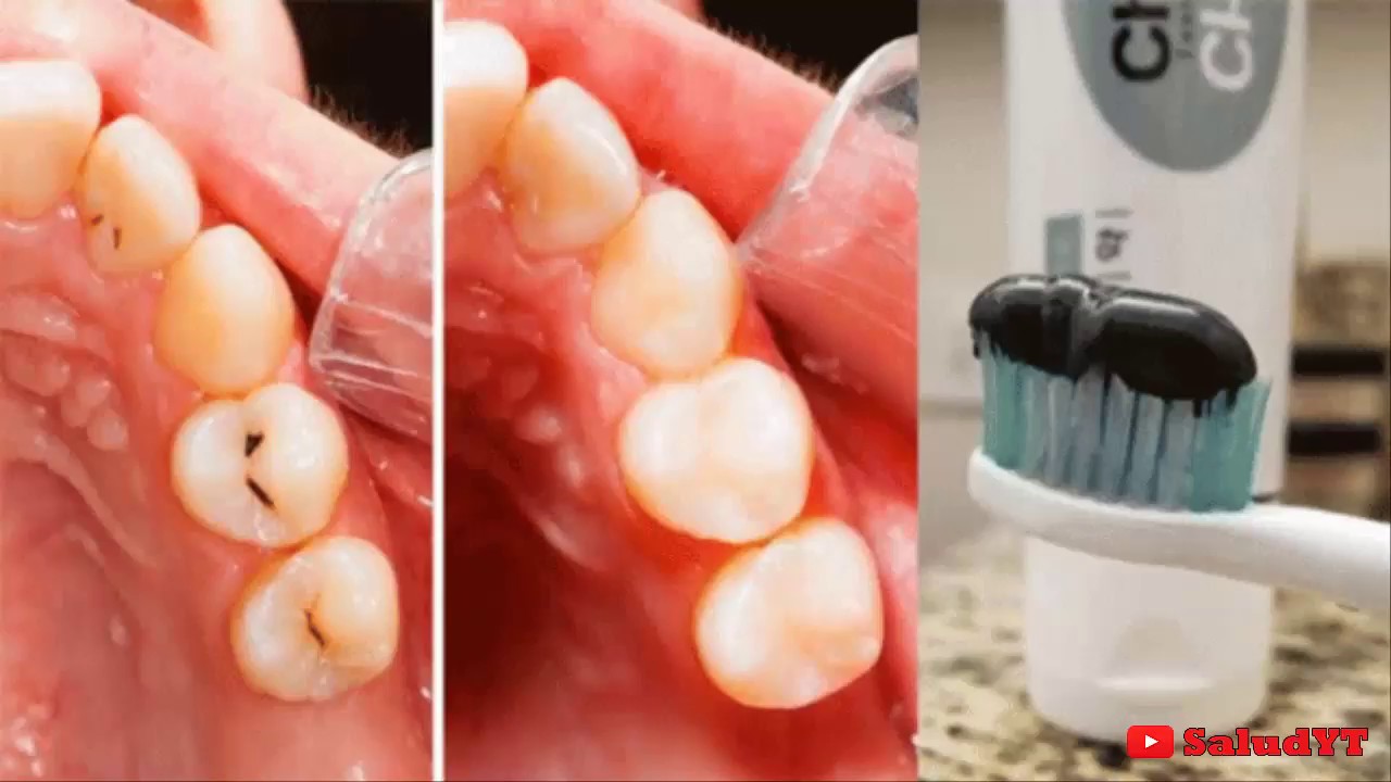 elimina las caries en 3 minutos