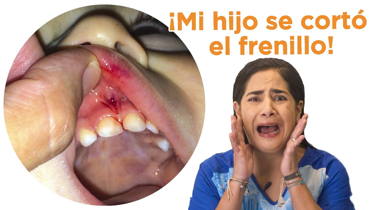 frenillo labial superior roto se regenera