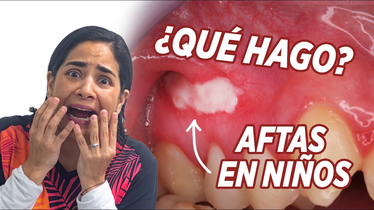 llagas en la lengua niños 2 años