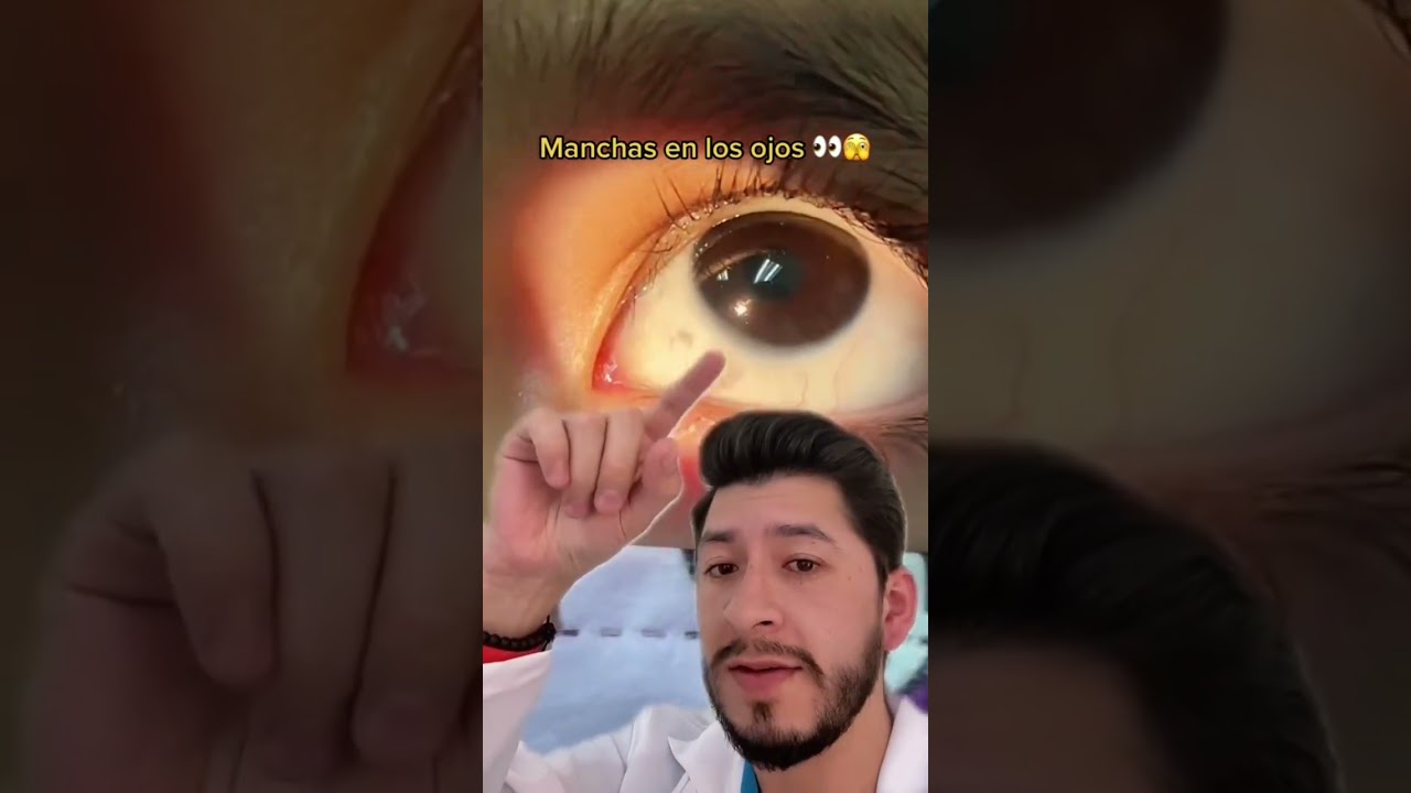 manchas grises en los ojos en niños