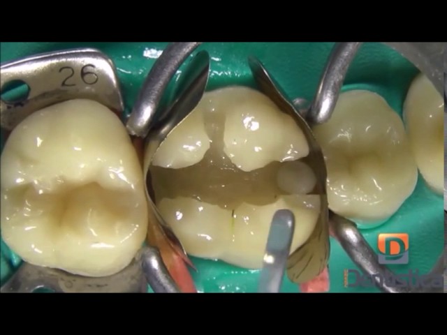 obturación dental con resina de fotocurado