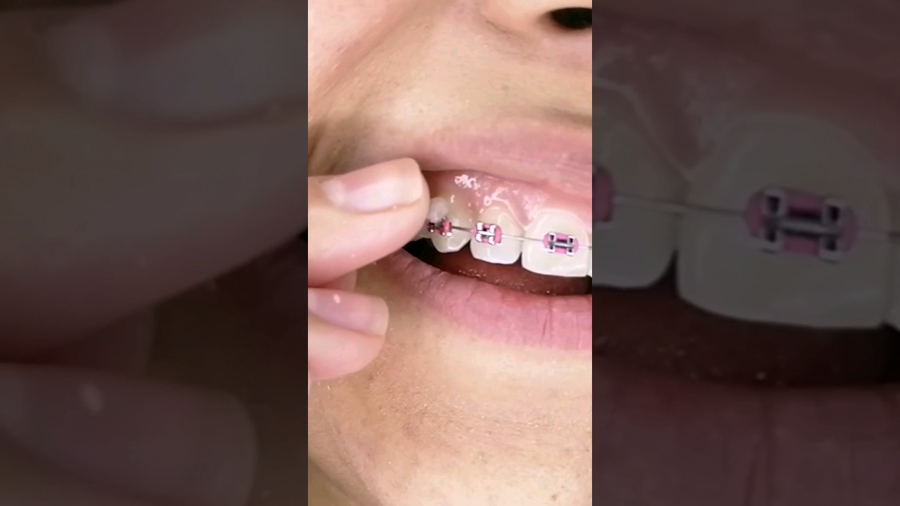 para que sirve la cera para brackets