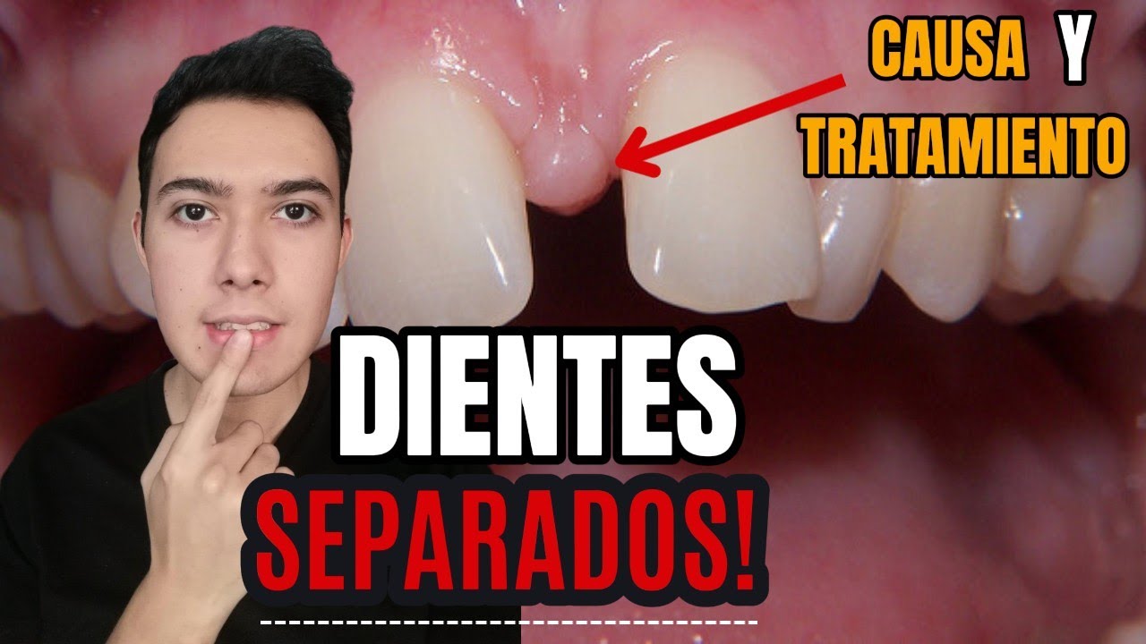porque los dientes se separan con la edad