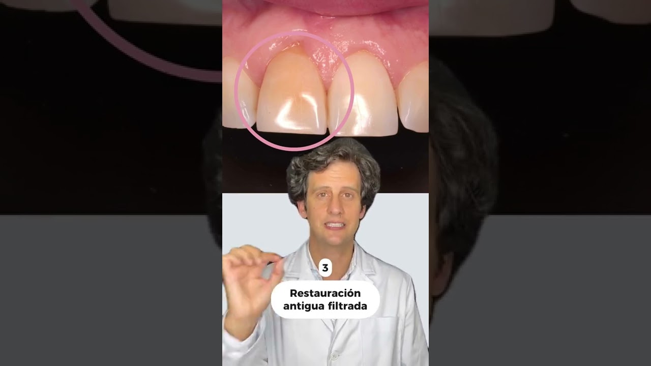 porque tengo un diente mas oscuro