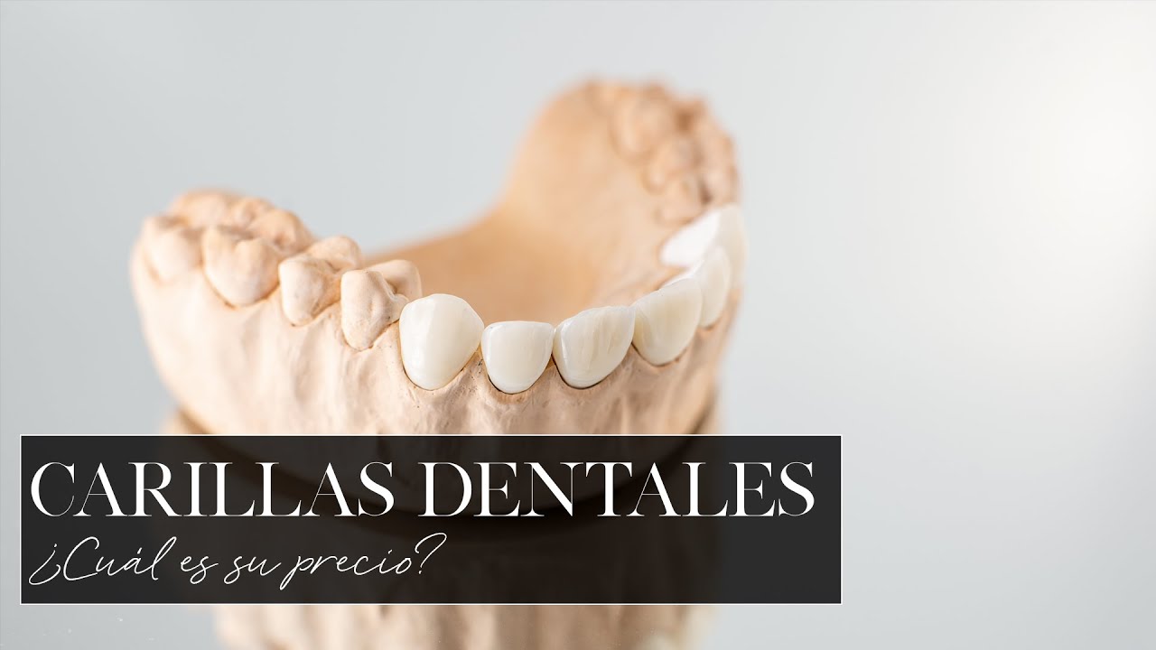 precio de las carillas dentales en españa