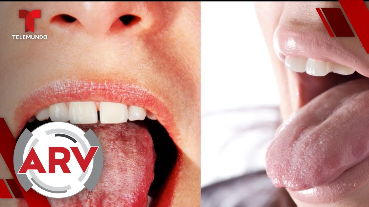 puntos blancos en la lengua y dolor