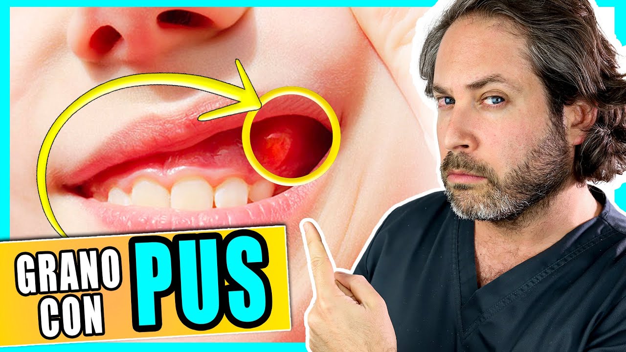 pus en las encias como curar