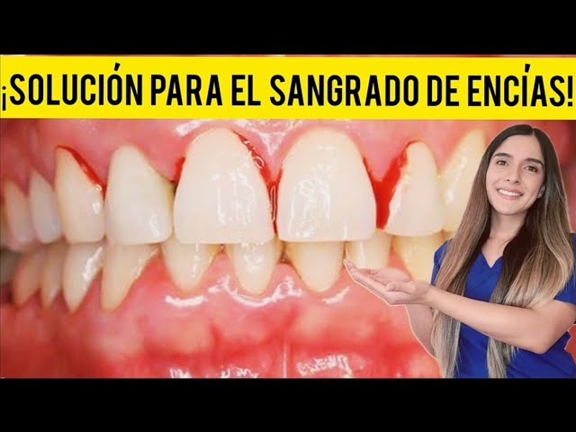 que causa sangrado en las encias