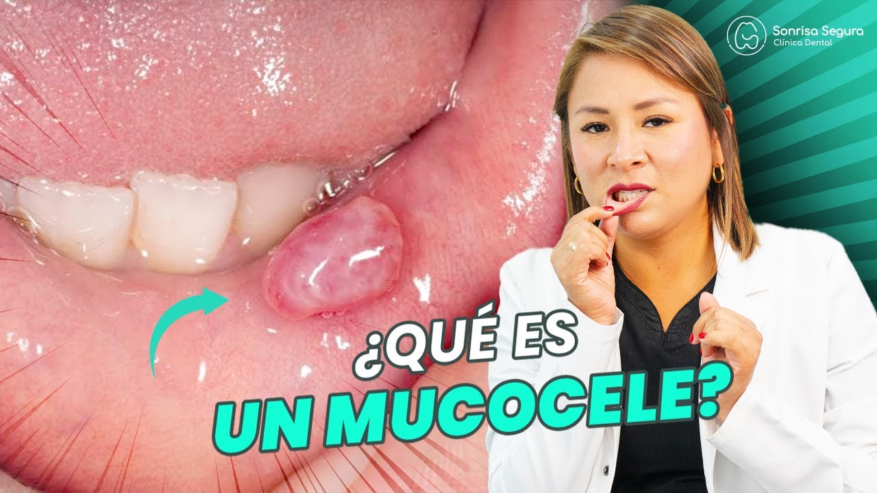 que es un mucocele en la boca