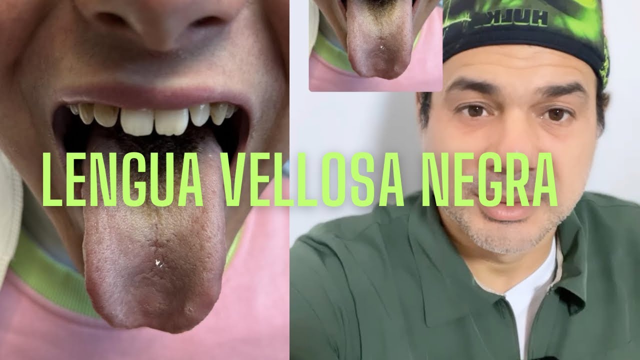 que significa tener la lengua negra