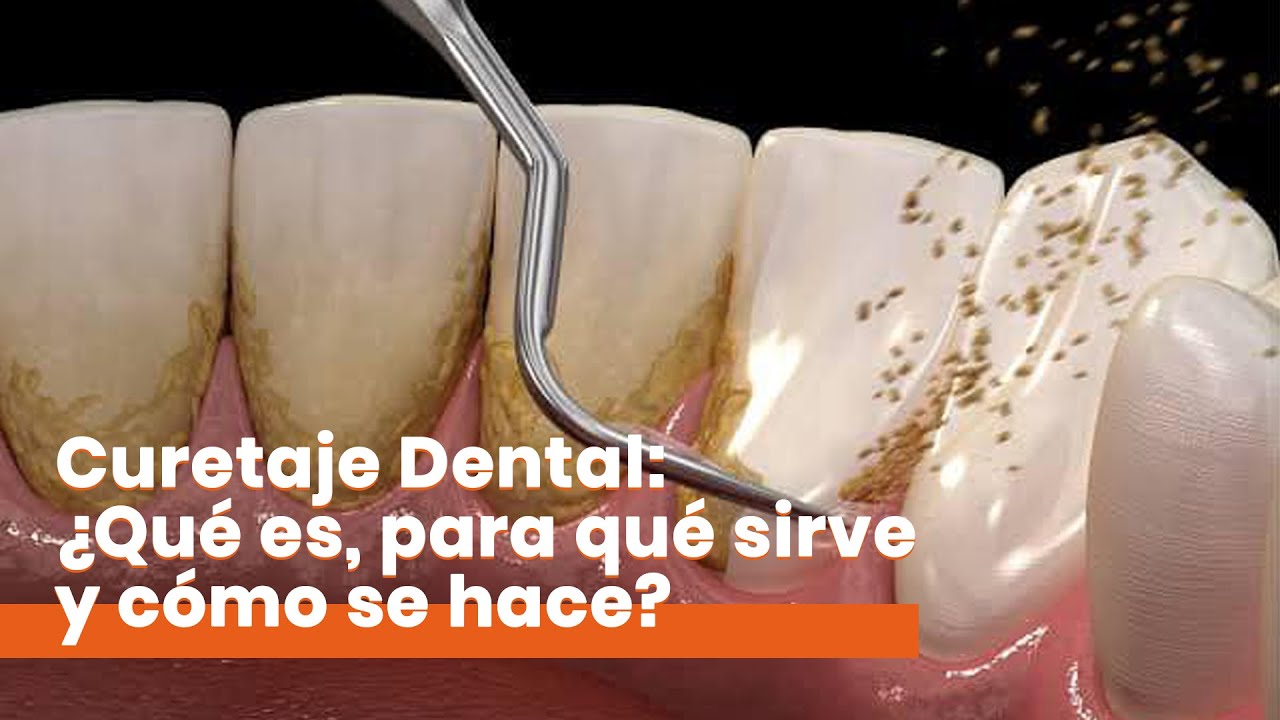 raspado y alisado radicular por cuadrante