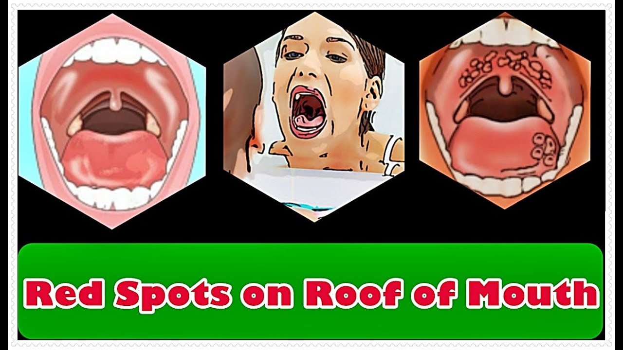 red marks in roof of mouth