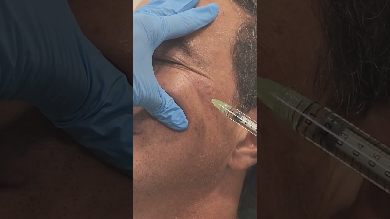 rellenar arrugas con acido hialuronico precio
