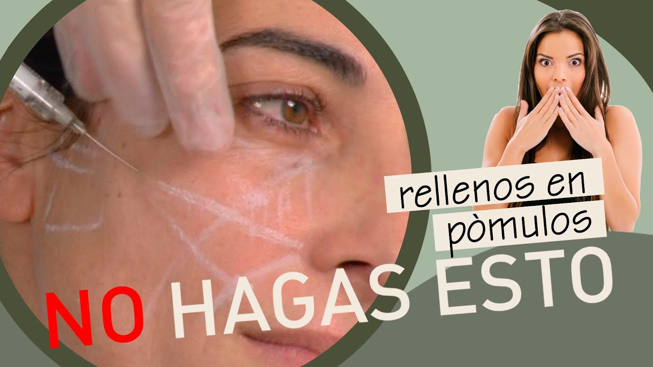 relleno surco nasogeniano antes y después