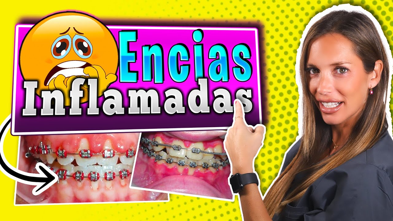 se inflaman las encias con los brackets