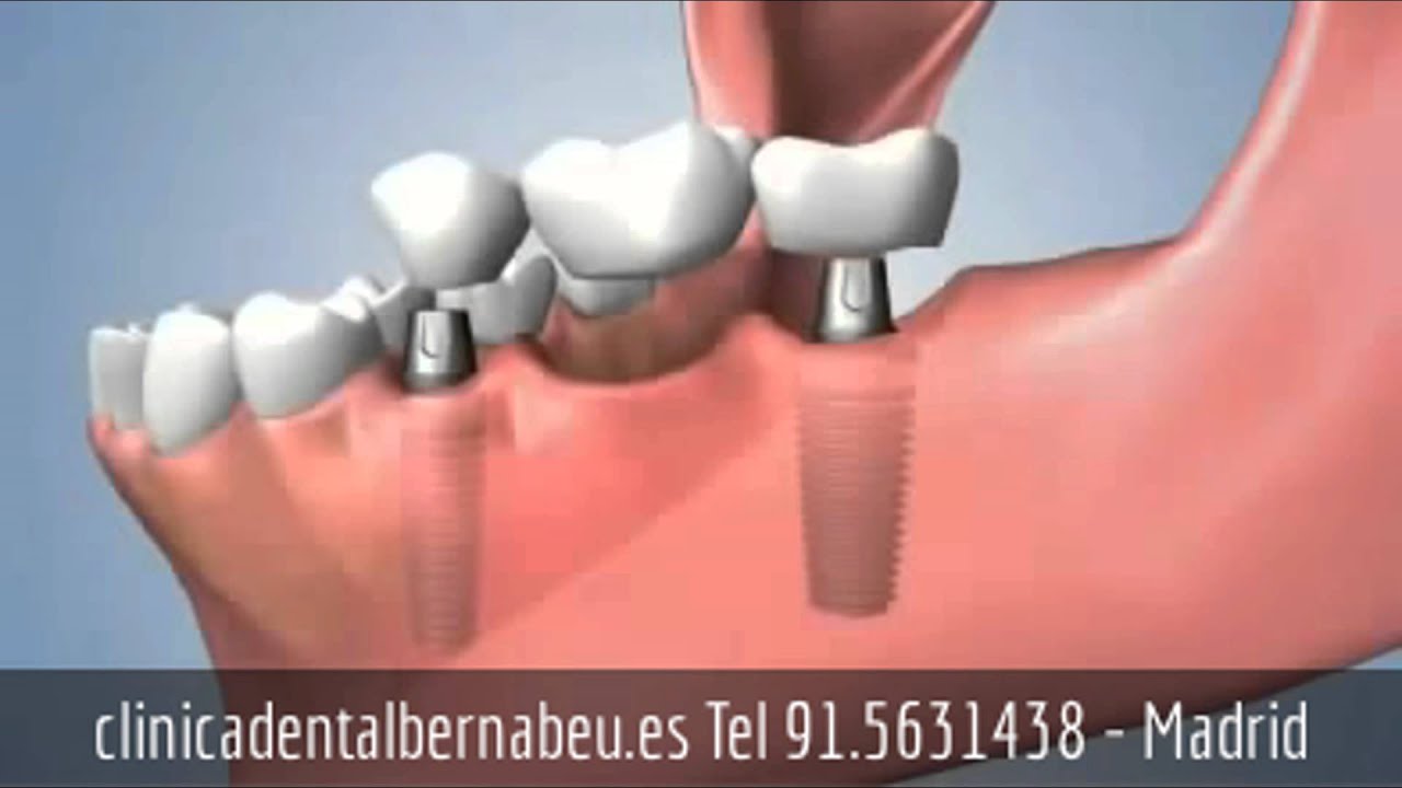 soluciones para falta de piezas dentales