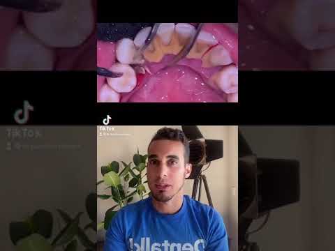 tratamiento para quitar el sarro delos dientes