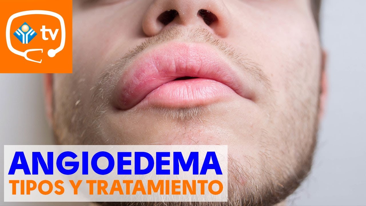 amaneci con el labio superior hinchado