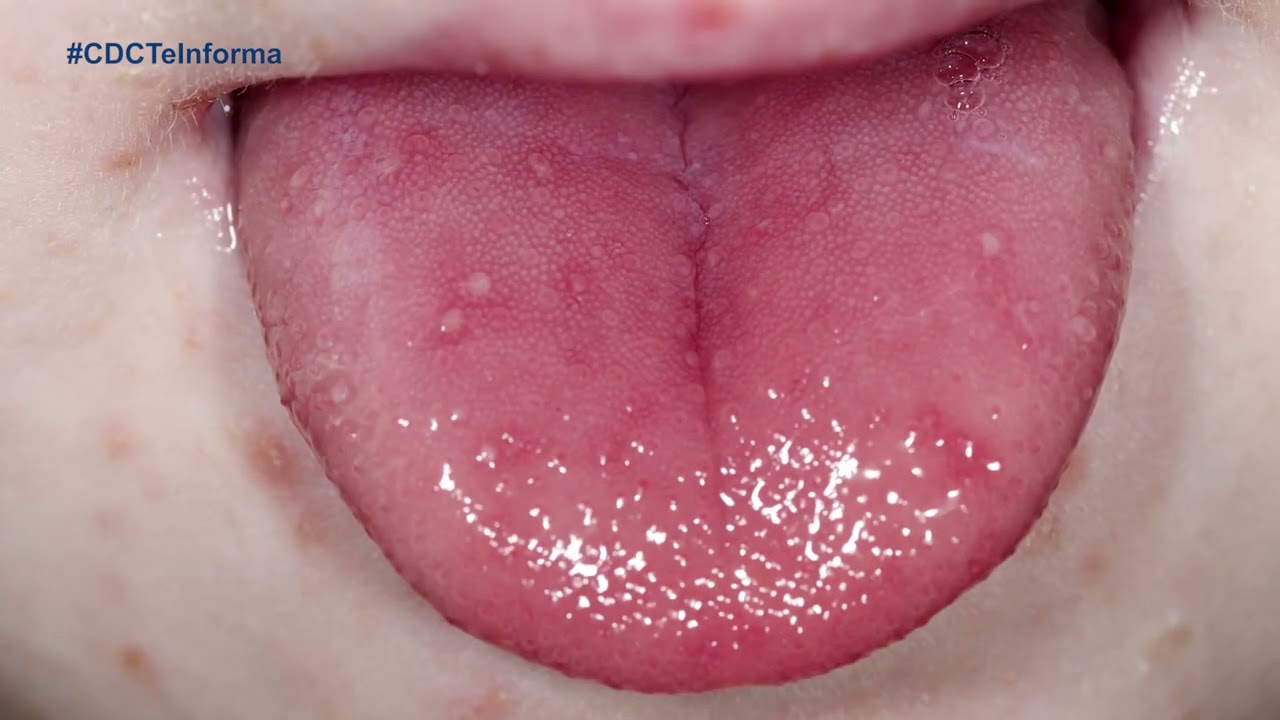 ampollas en la lengua en niños
