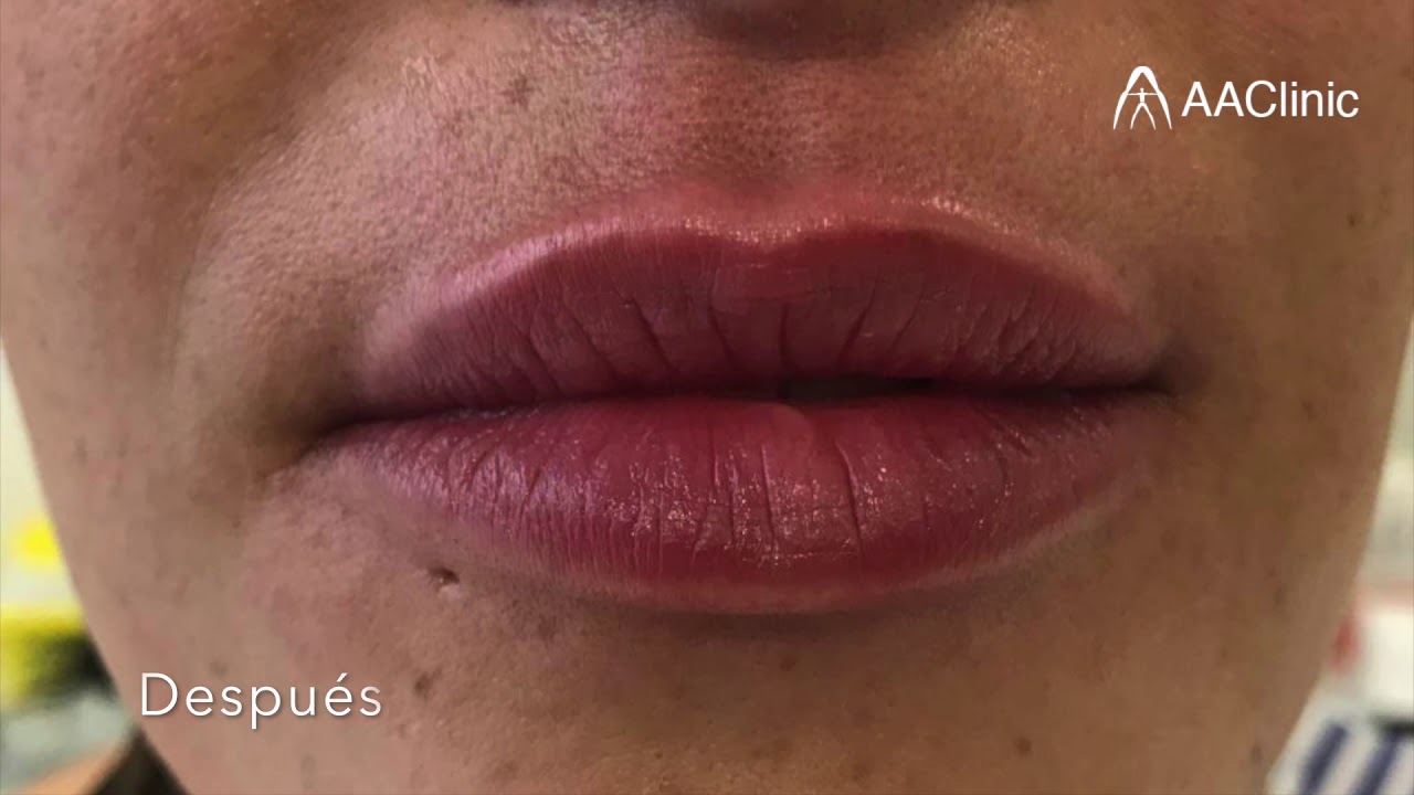 antes y despues relleno de labios