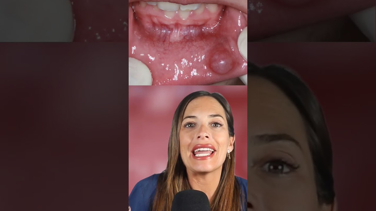 bulto en la mejilla interna con dolor