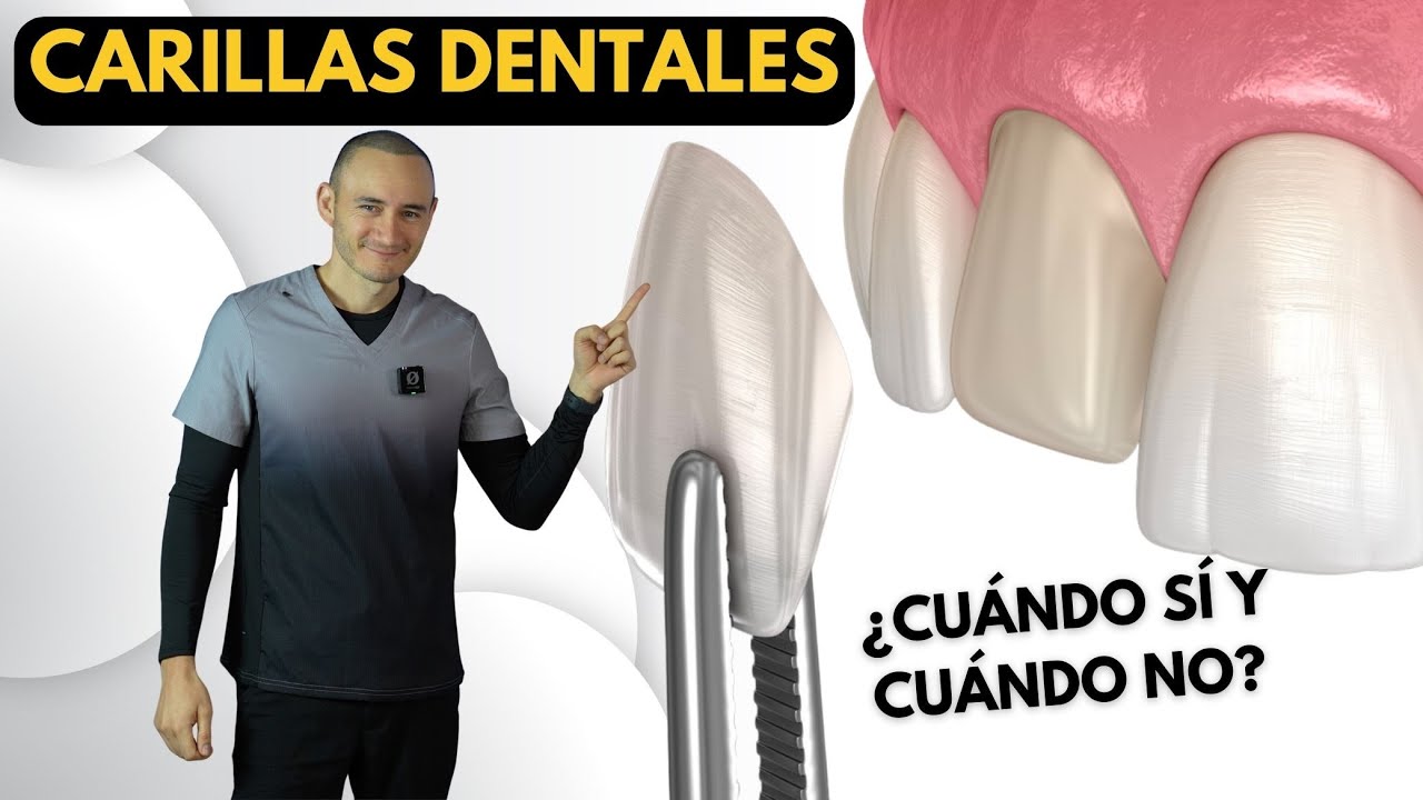 carillas de porcelana antes y despues