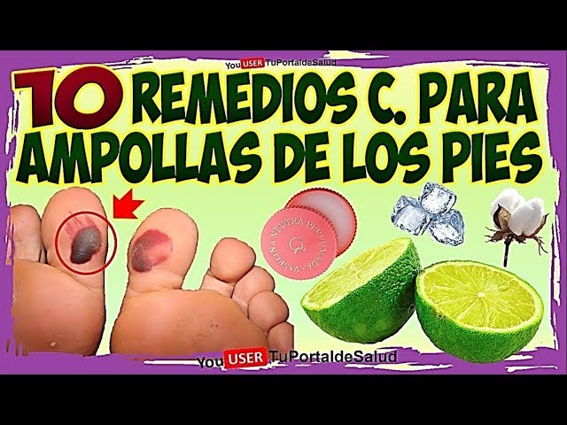 como curar ampollas en los pies remedios caseros