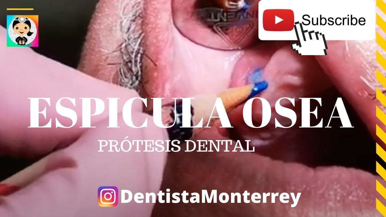 como quitar una espícula de hueso