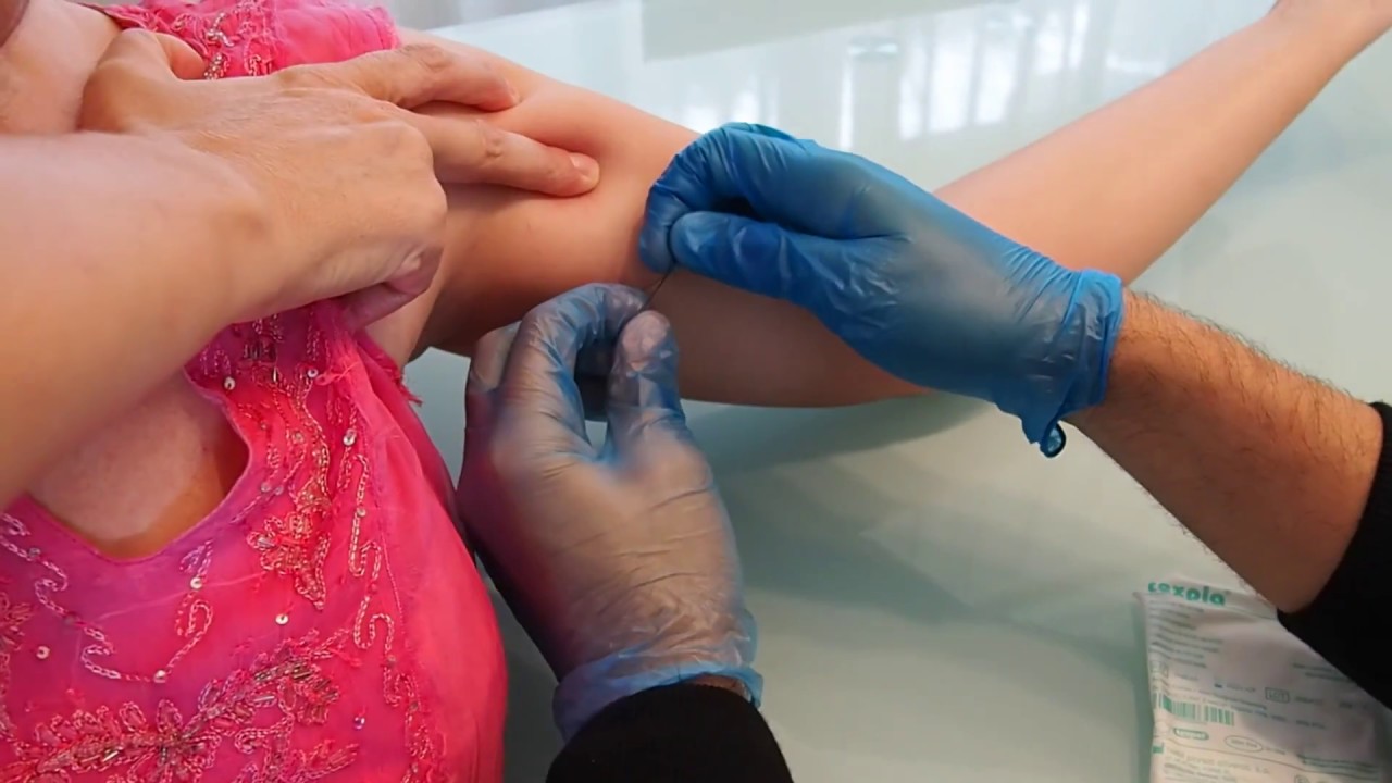 como quitar una verruga con hilo