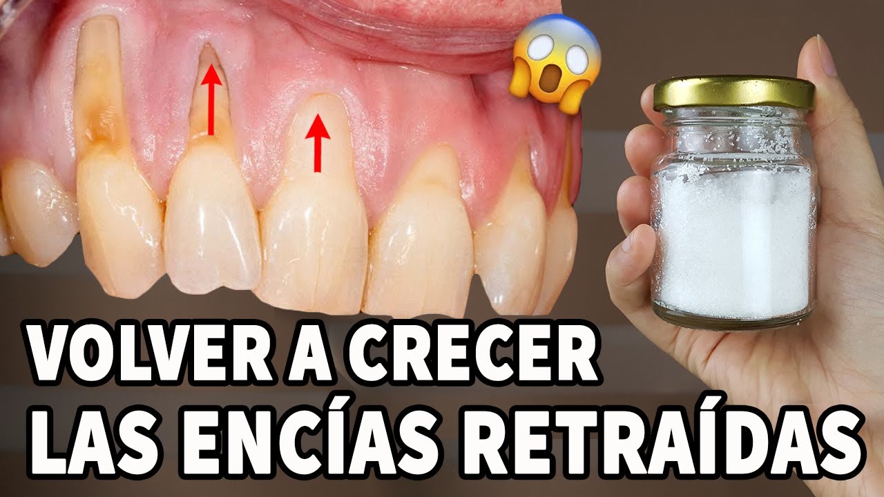 como sanar encias retraidas remedios caseros para
