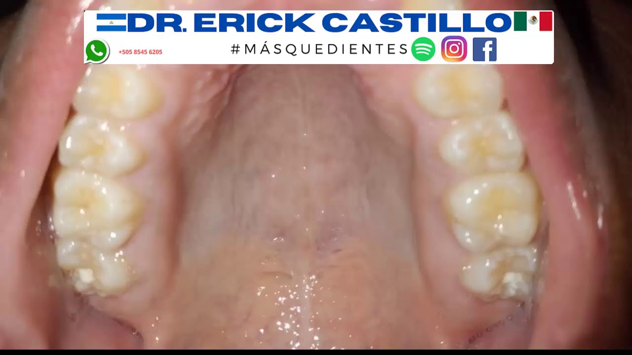 como se ve un paladar sano