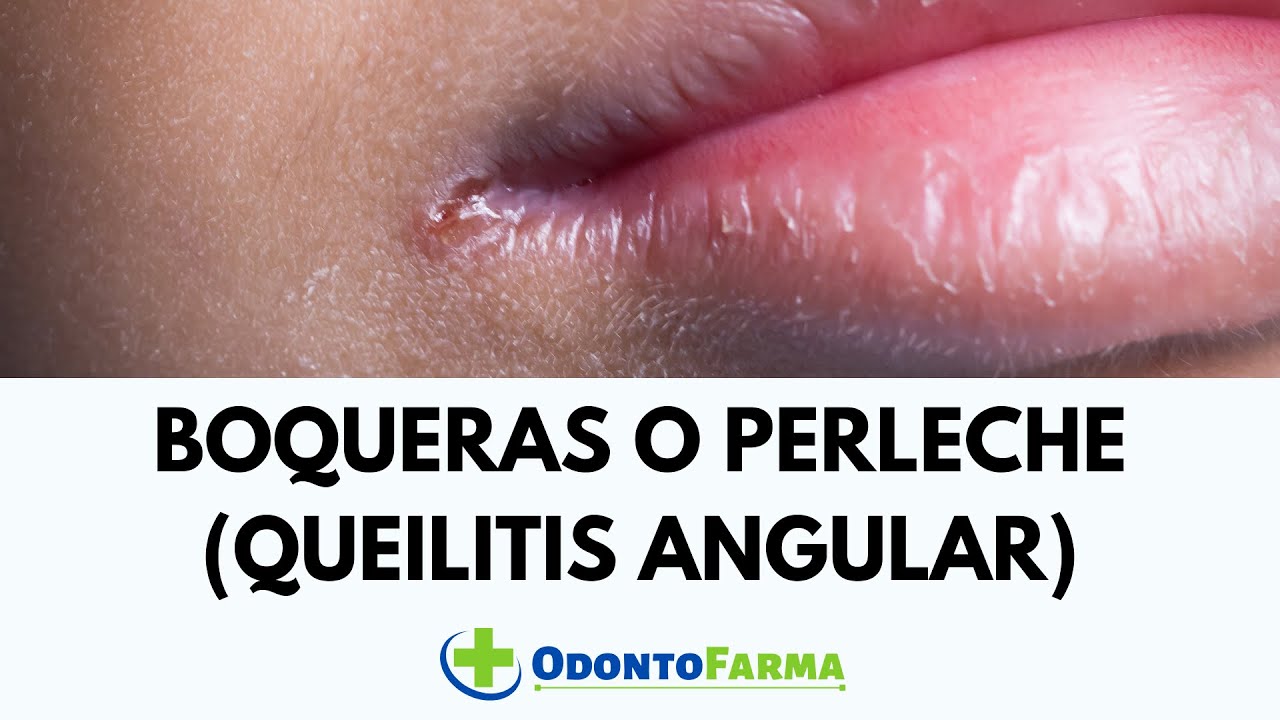 cortada en la comisura de los labios