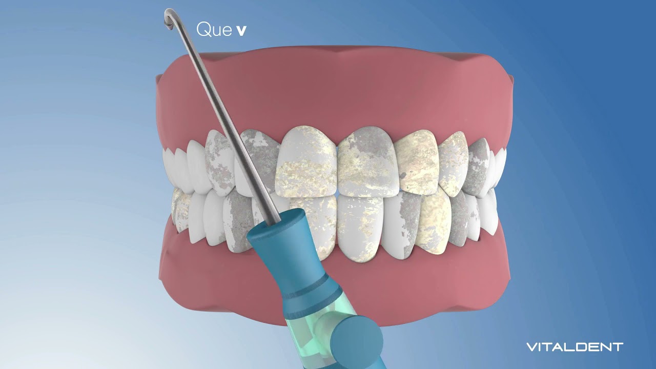 cuanto cuesta un curetaje en vitaldent