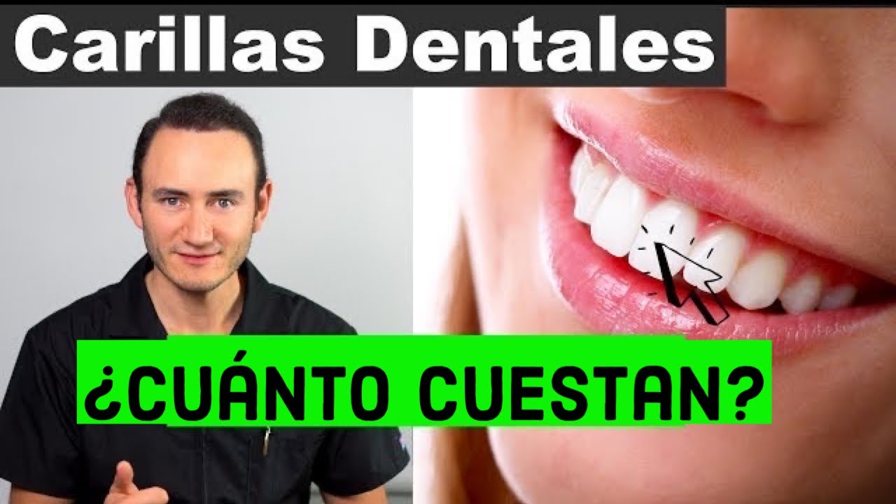 cuanto cuestan las carillas de composite