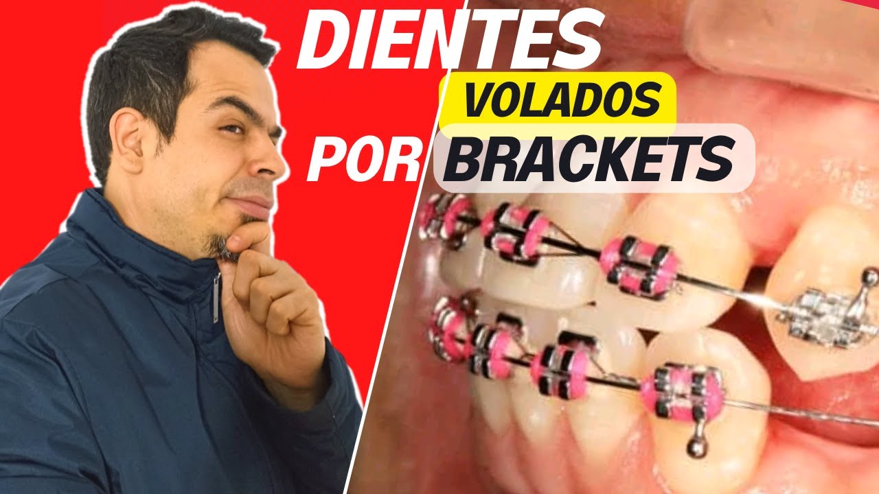 dientes hacia afuera despues de brackets