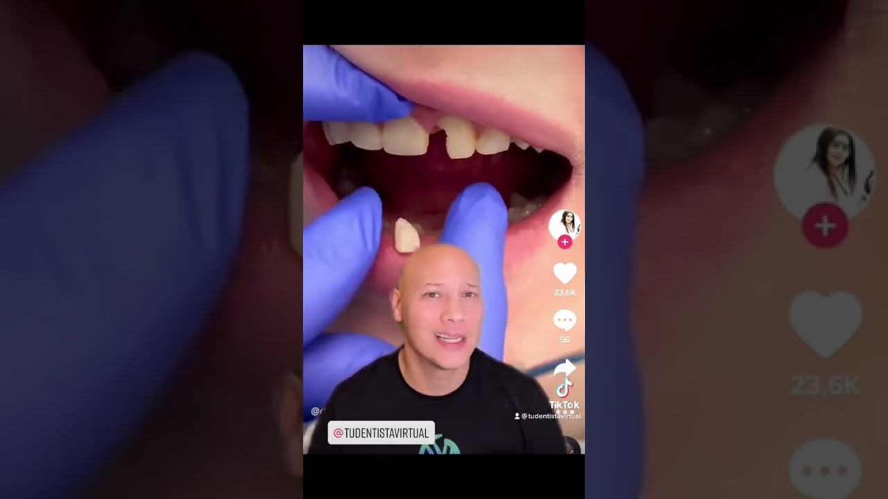empaste se cae al día siguiente