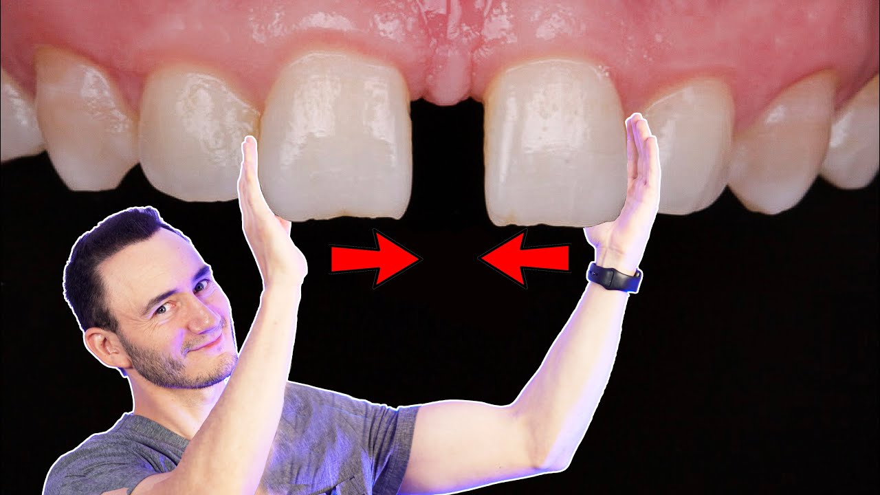 espacio de separación entre los dientes