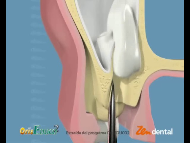 fractura de la tuberosidad del maxilar