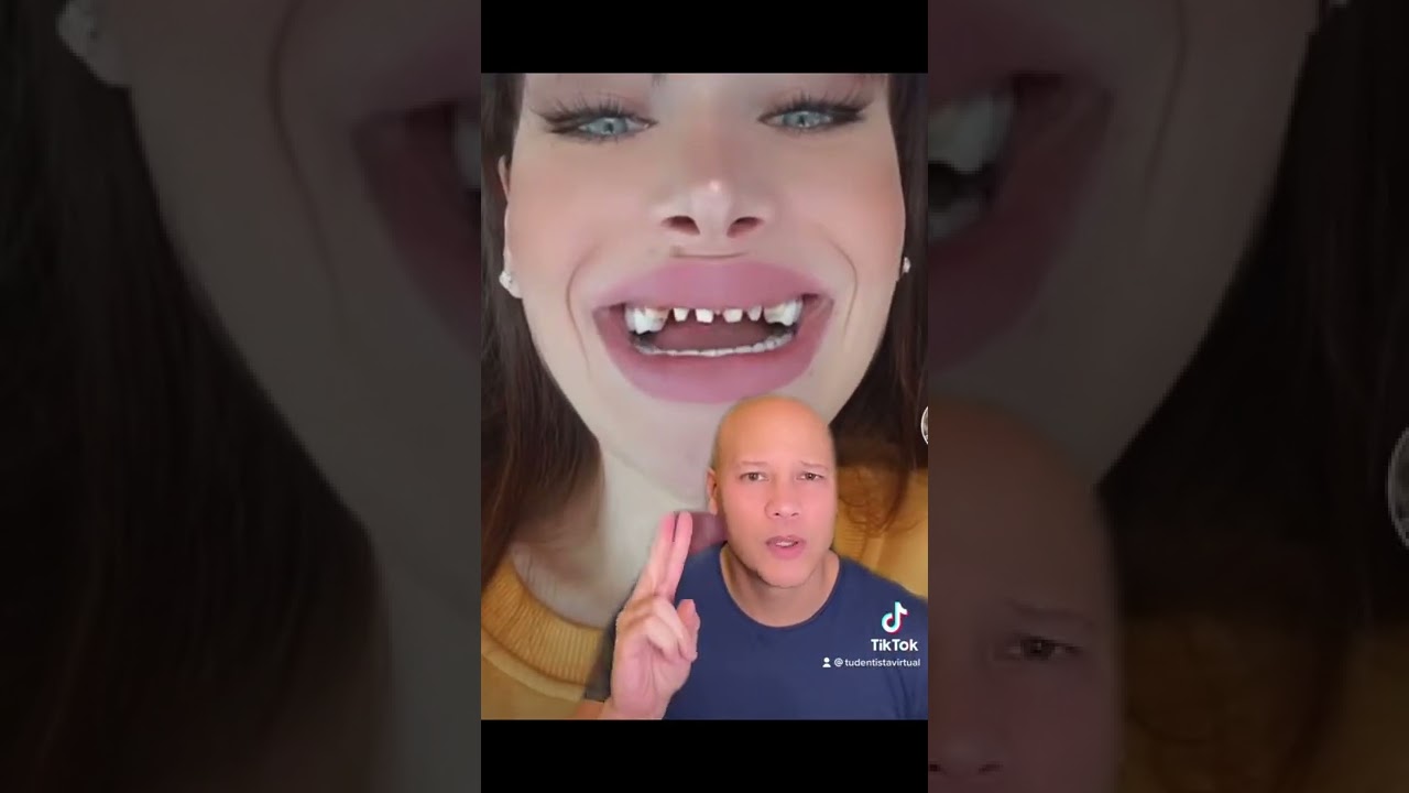 fundas dentales en toda la boca