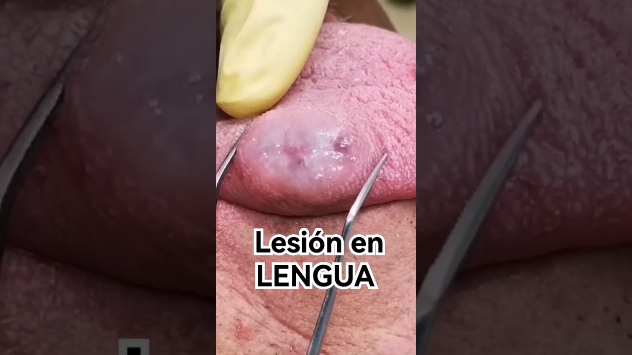 hematoma en la lengua por mordedura
