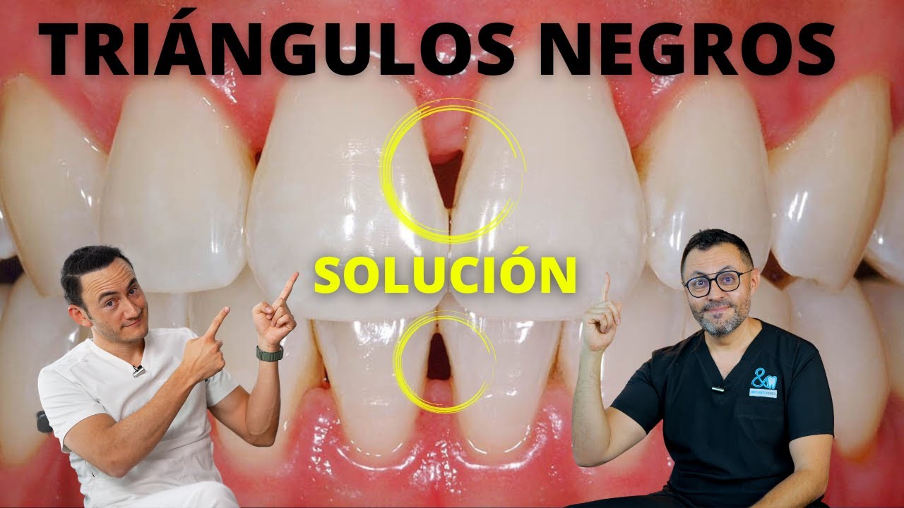 hoyos en los dientes de enfrente