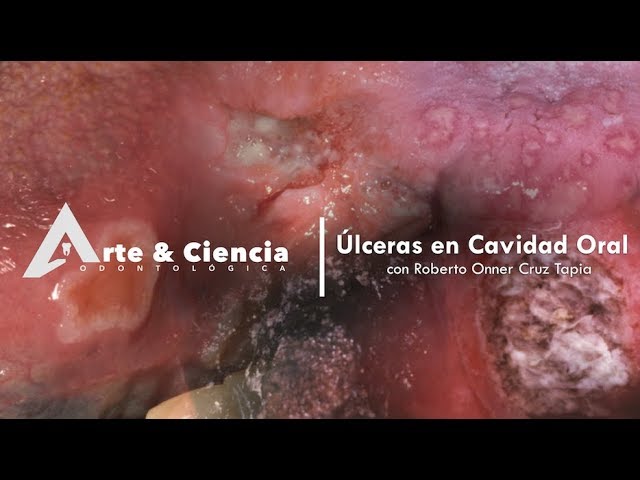 imágenes de úlceras en la garganta