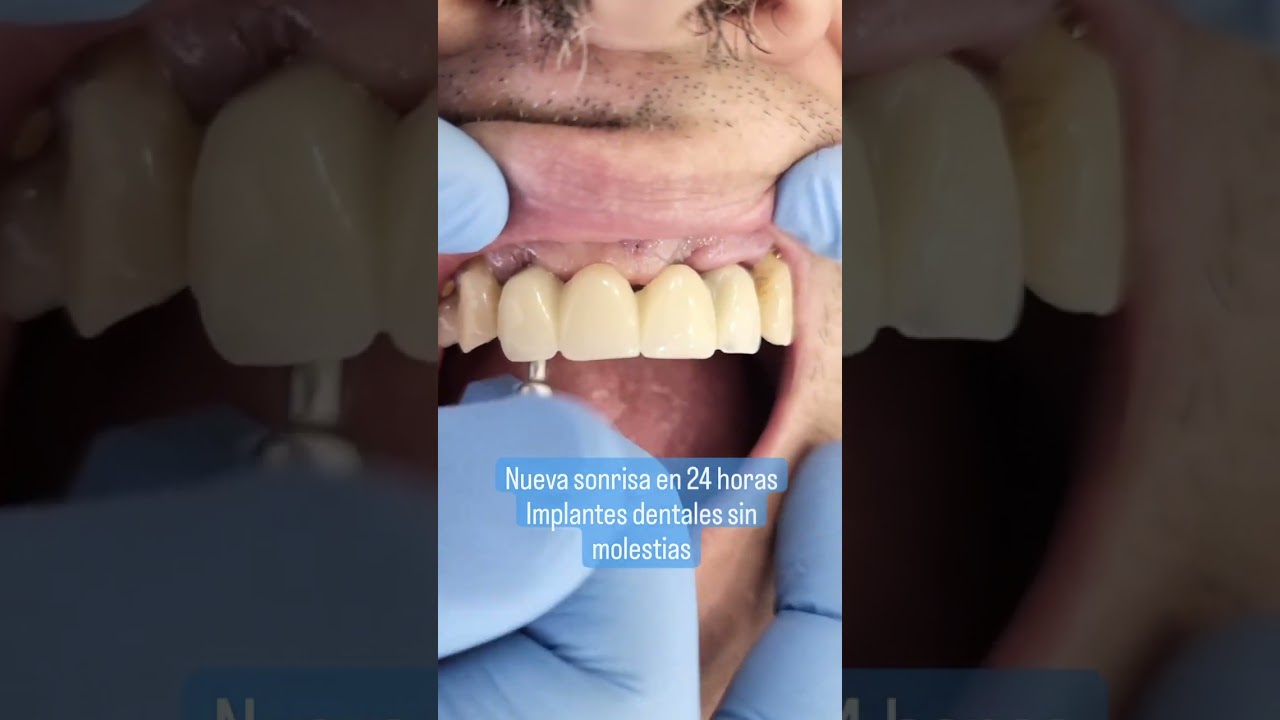 implante dental protesis dental fija antes y despues